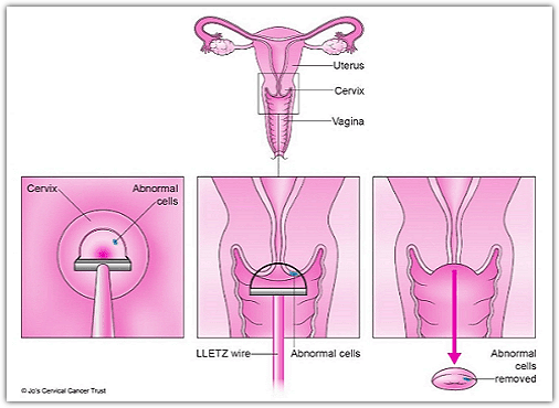 자궁경부 원추절제술이란